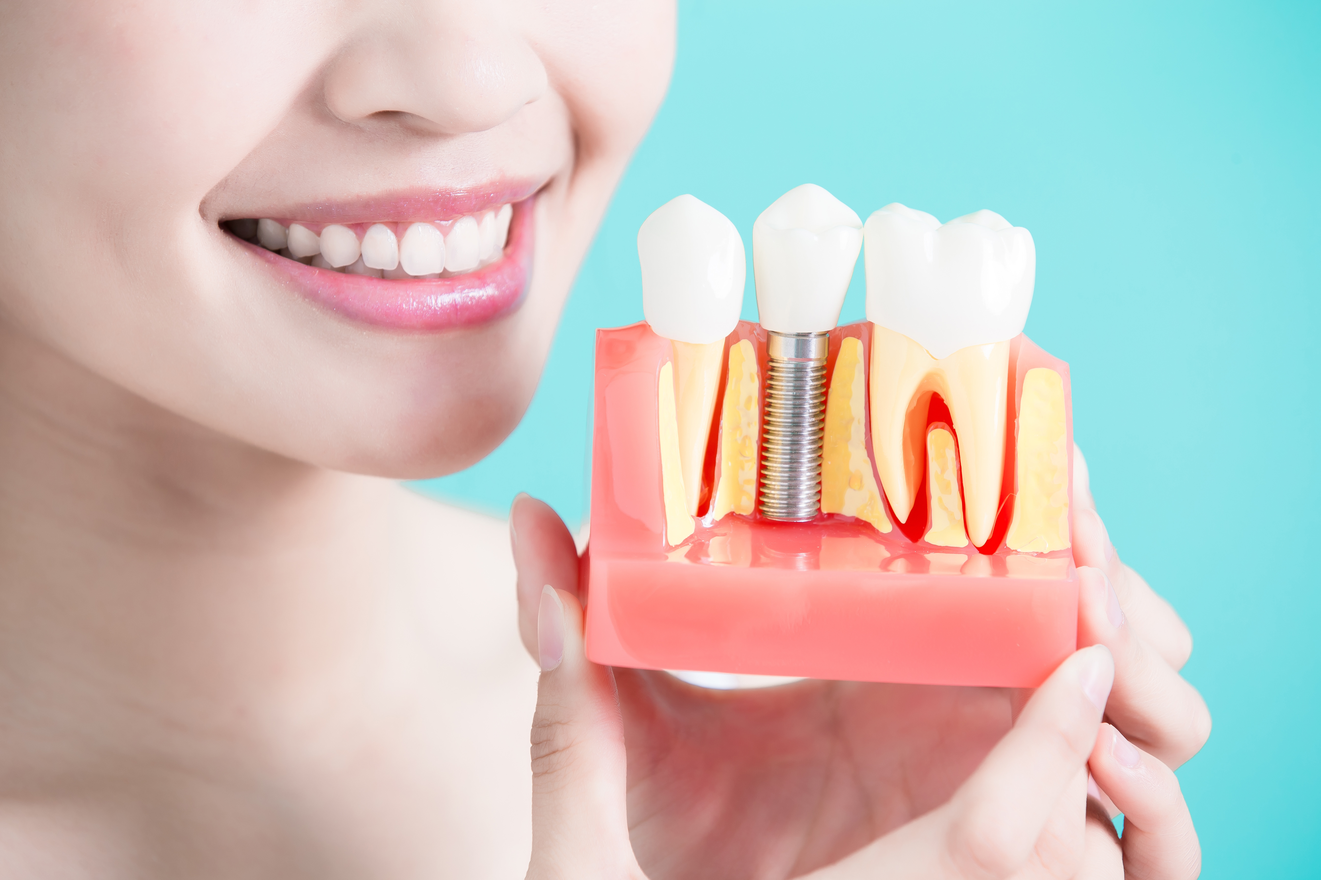 DENTAL IMPLANTS