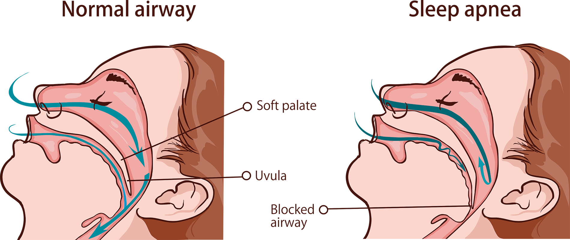 sleep apnea treatment paoli pa